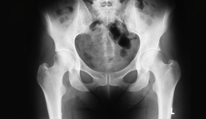 male vs female pelvis x ray