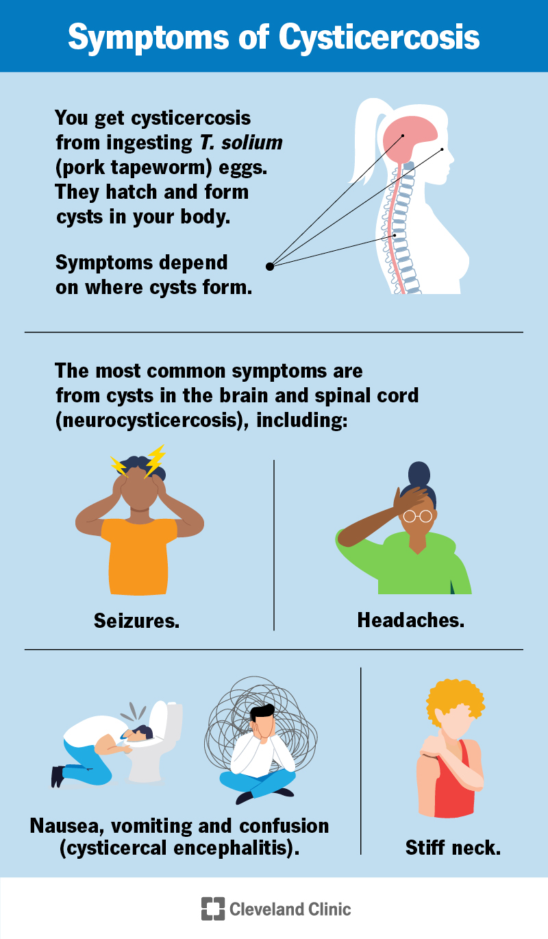 Common symptoms of cysticercosis are seizures, headaches, stiff neck, vomiting and confusion, but depend on where cysts are.