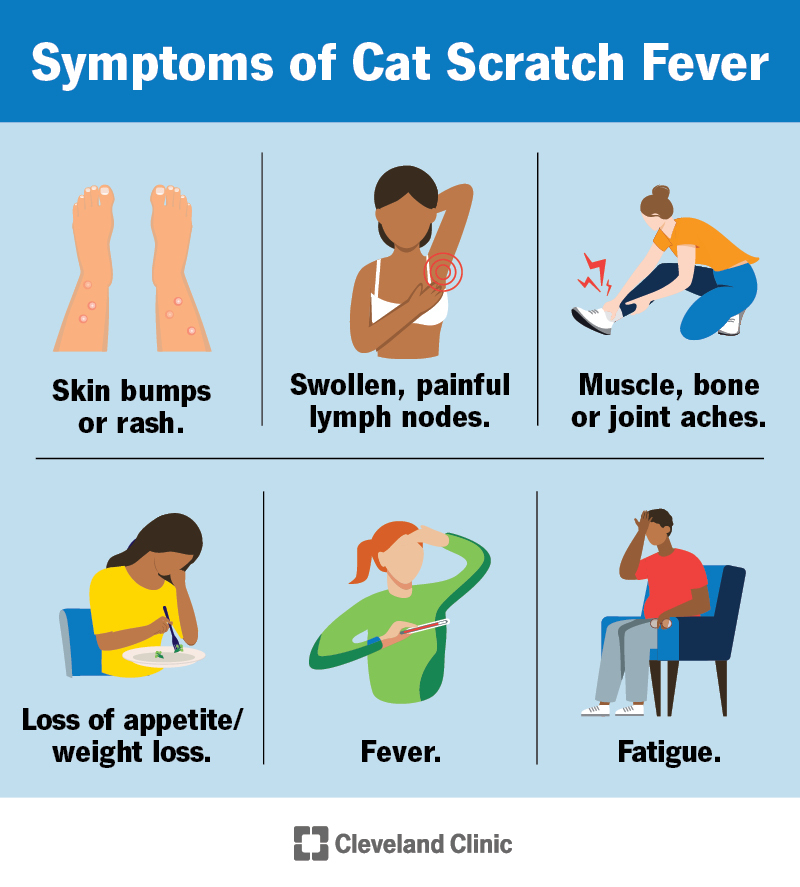 Symptoms of cat scratch fever include rash, swollen lymph nodes, aches and pains, loss of appetite, fever and fatigue.