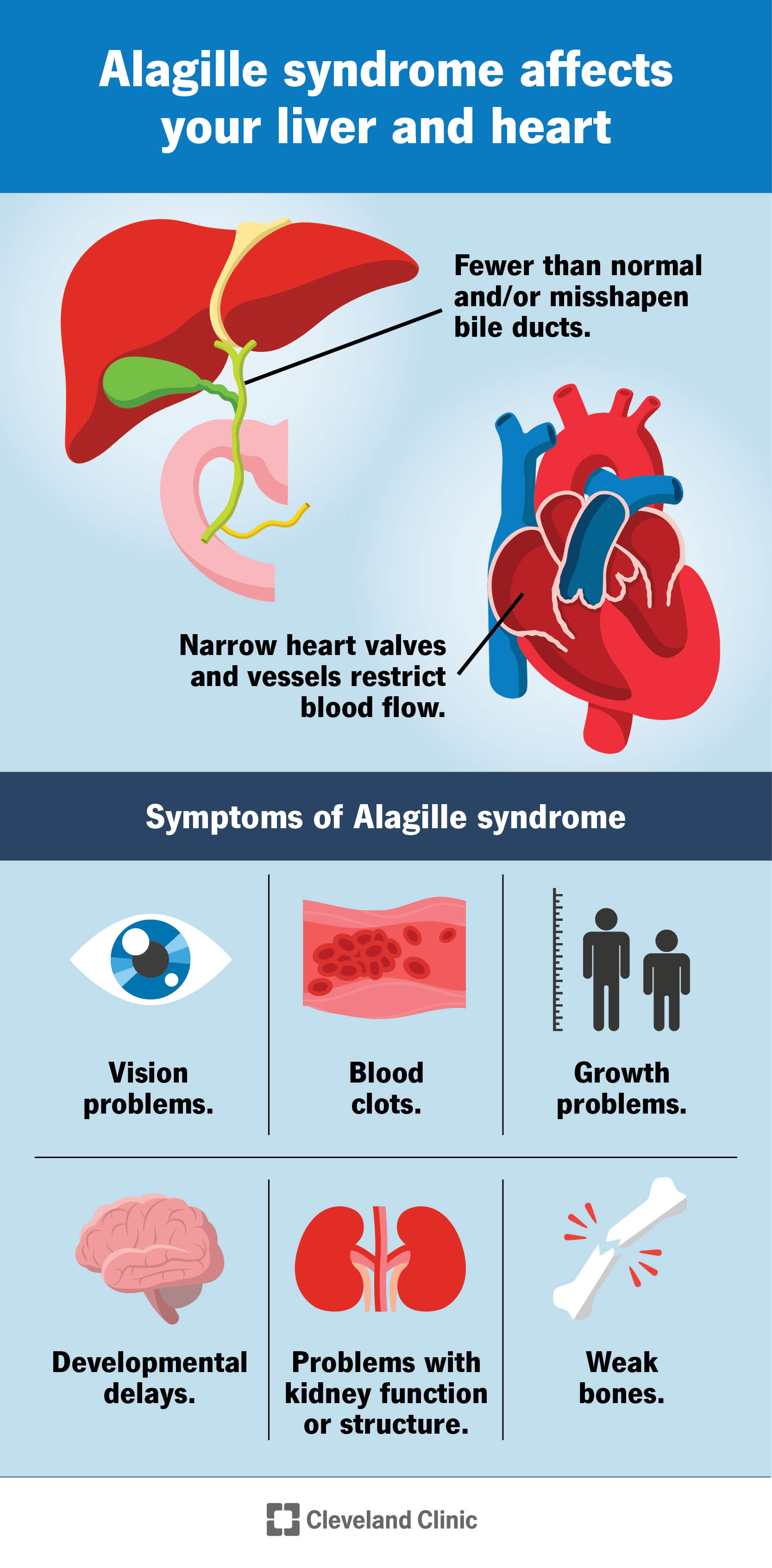 Alagille syndrome affects your heart and liver and causes other symptoms throughout your body.
