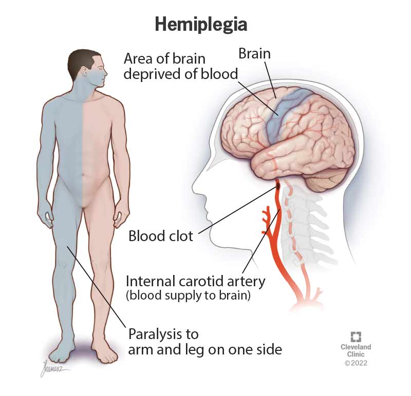 Hemiplegia is paralysis that affects one side of your body. It can affect the face, arm and leg.