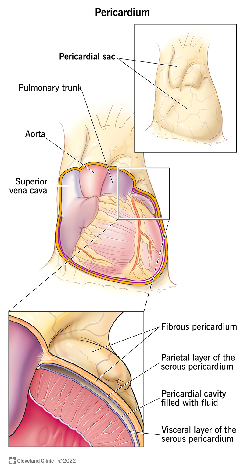 fluid in the pericardial sac