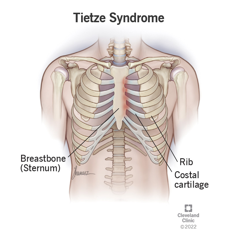 An illustration of Tietze syndrome in a ribcage