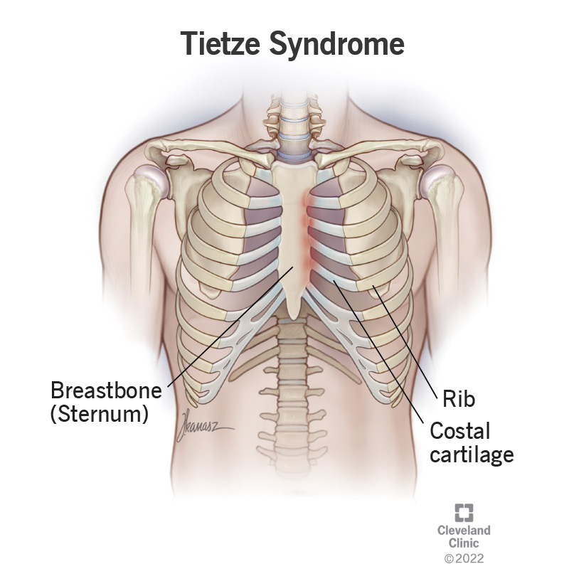 sindromul Tietze