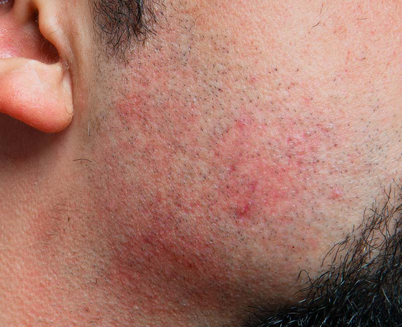 A blotchy red skin rash on a person’s face and neck caused by razor burn.