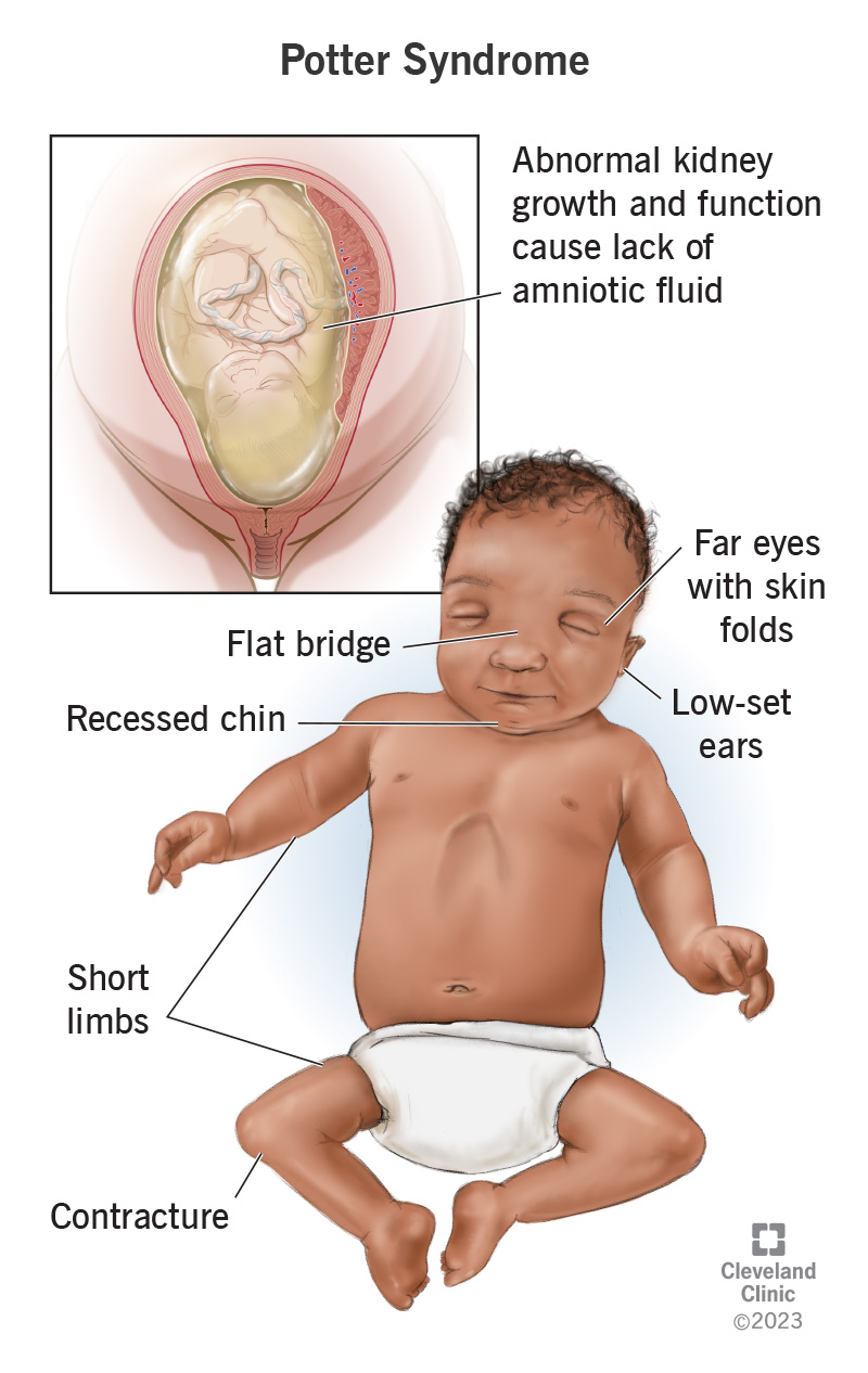 An illustration of a fetus in a uterus with too little amniotic fluid and a baby with physical symptoms of Potter syndrome.
