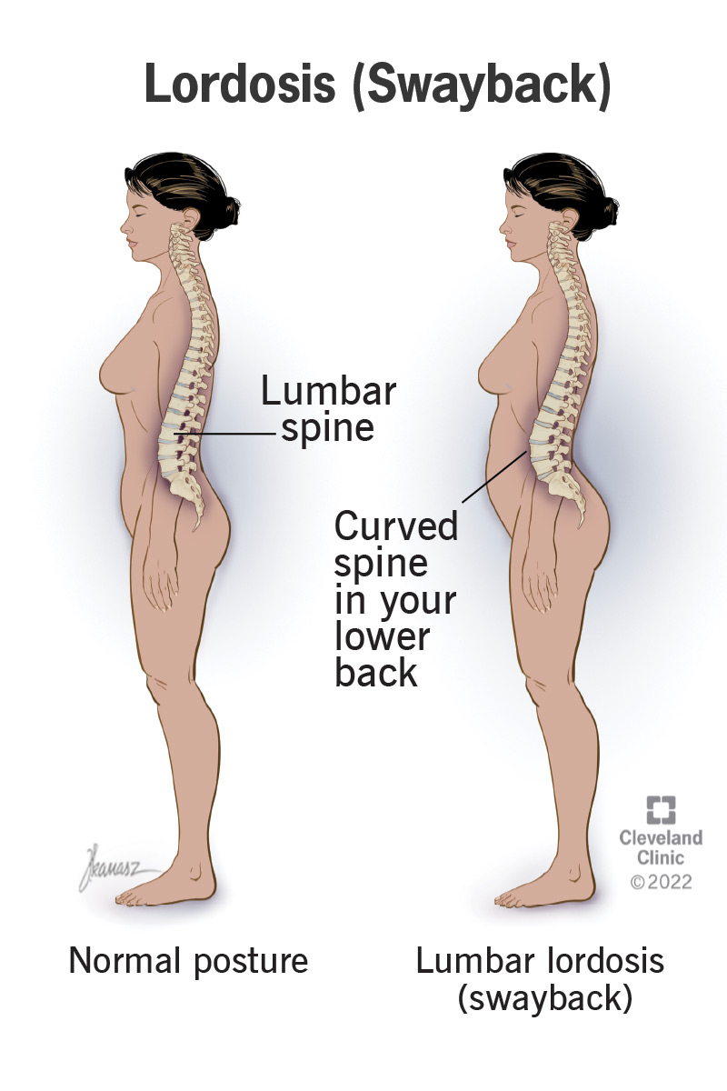 An illustration of lordosis in a person's lumbar spine (lower back)