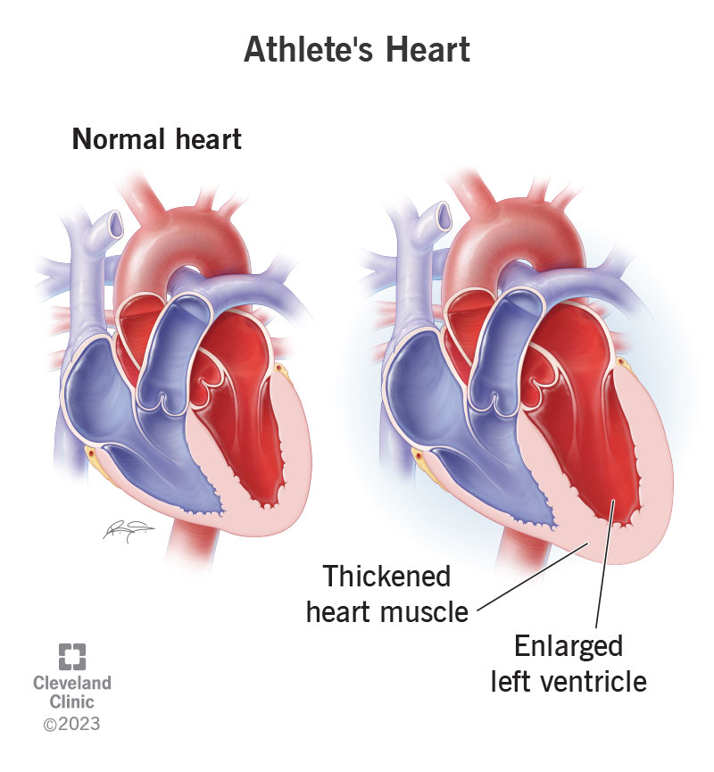 Athlete’s heart increases the size and wall thickness of an athlete’s left ventricle.