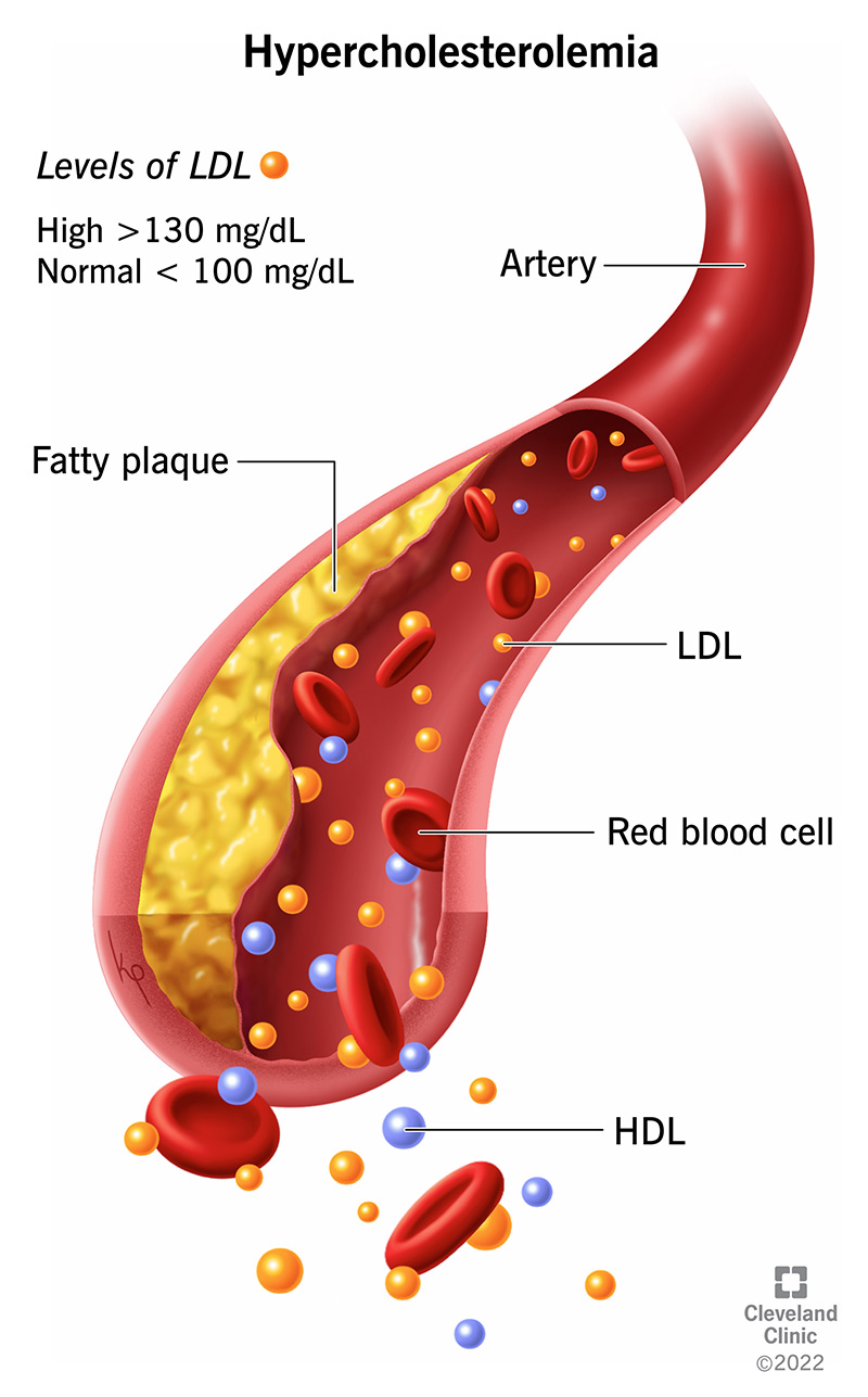 LDL (bad cholesterol) collects in a blood vessel to form fatty plaque.