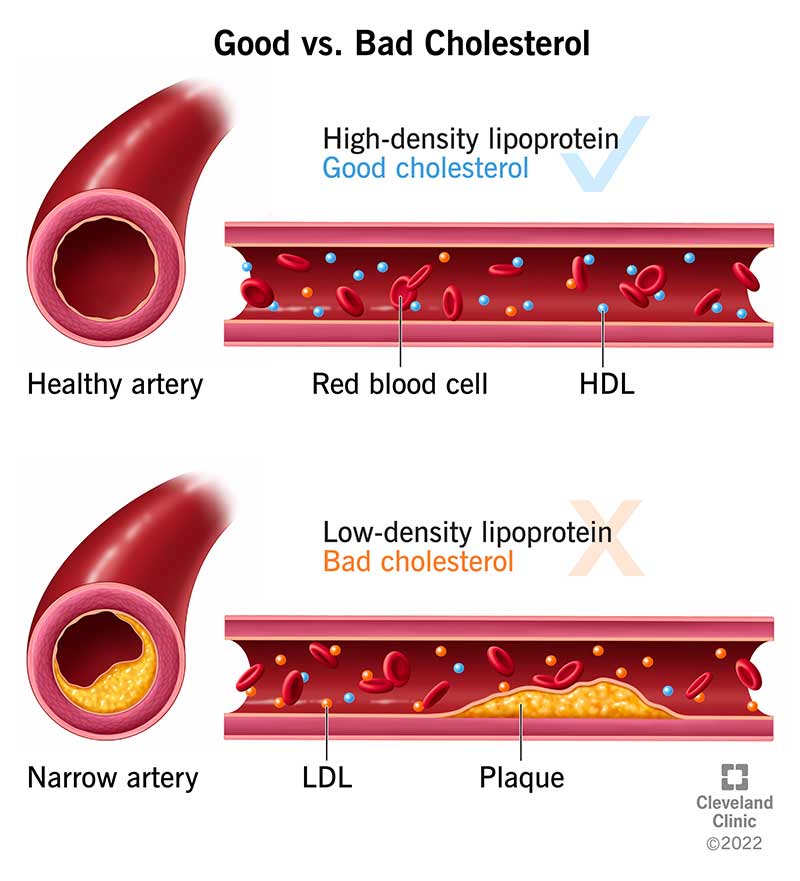 Illustration of a healthy artery versus a narrow artery. Bad cholesterol (LDL) contributes to plaque formation in the narrow artery.