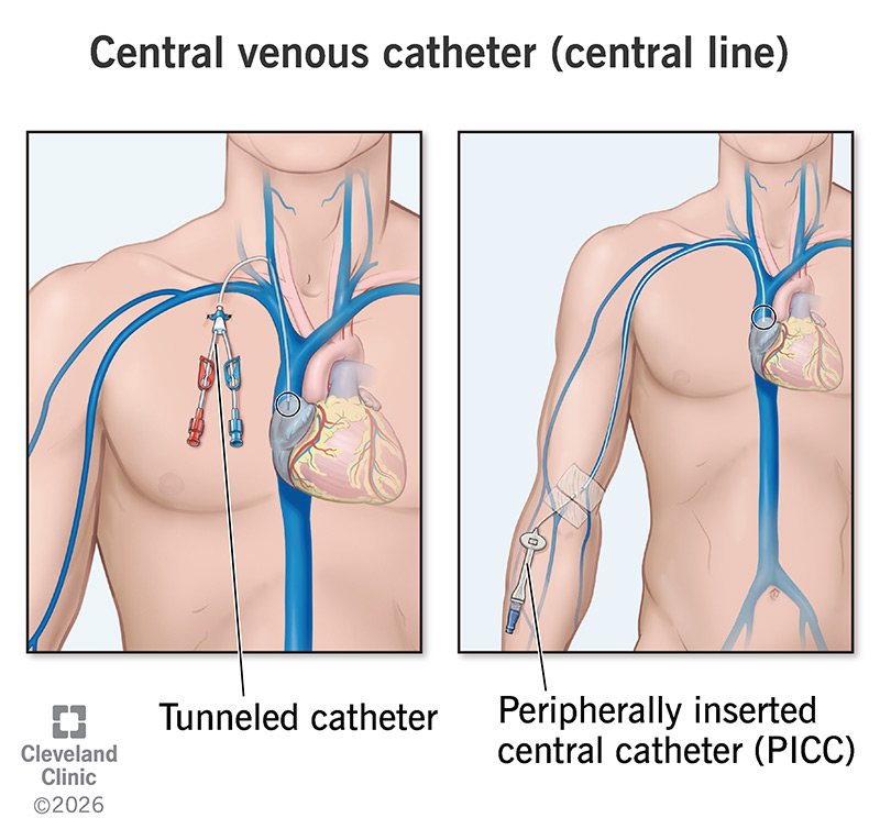 A person with a tunneled catheter and a person with a PICC line