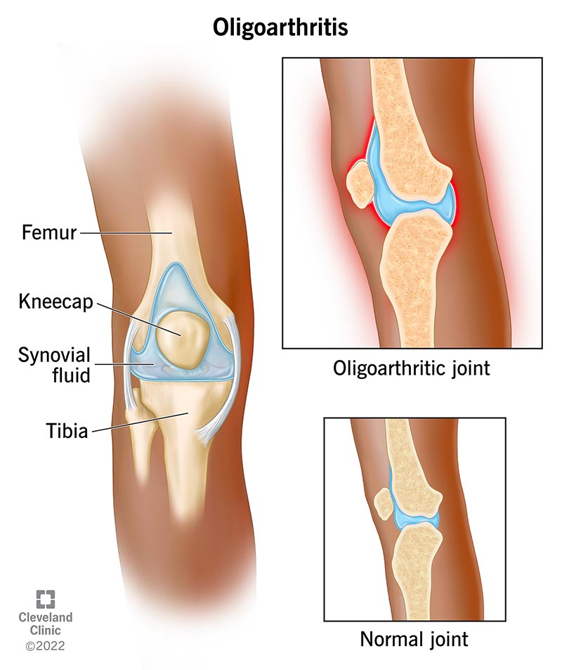 Oligoarthritis causes joint pain and swelling in your body’s large joints. It makes your joints feel tight and look larger than normal.