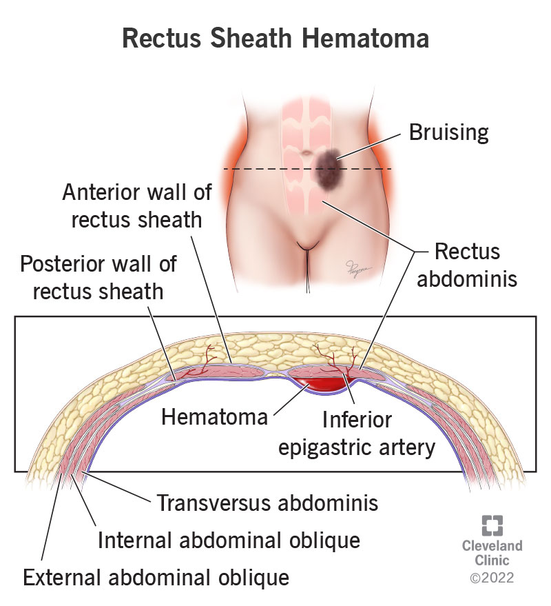 A rectus sheath hematoma can occur when blood collects within your rectus sheath, the connective tissue that contains your abdominal muscles.