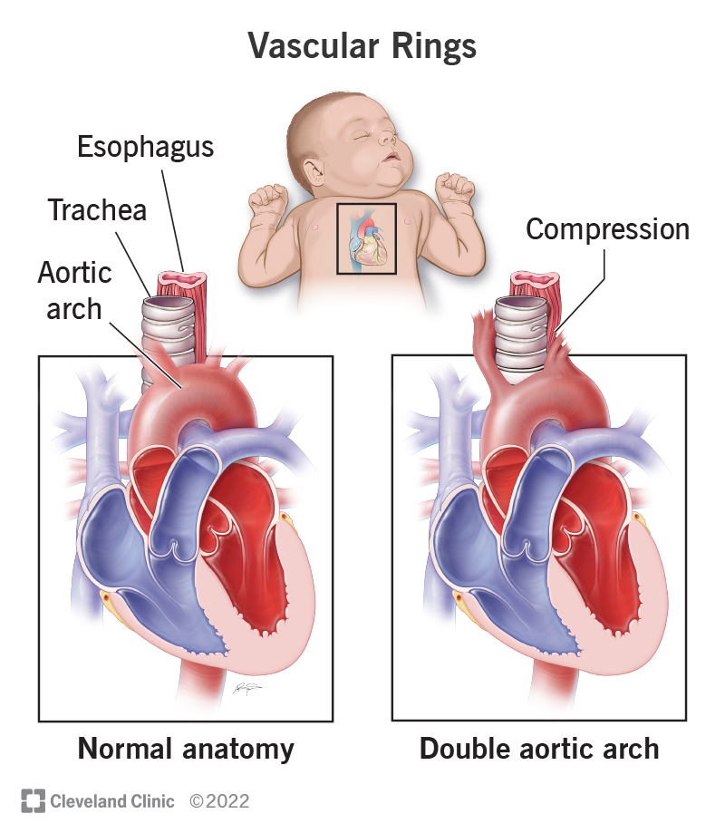 aortic ring surgery