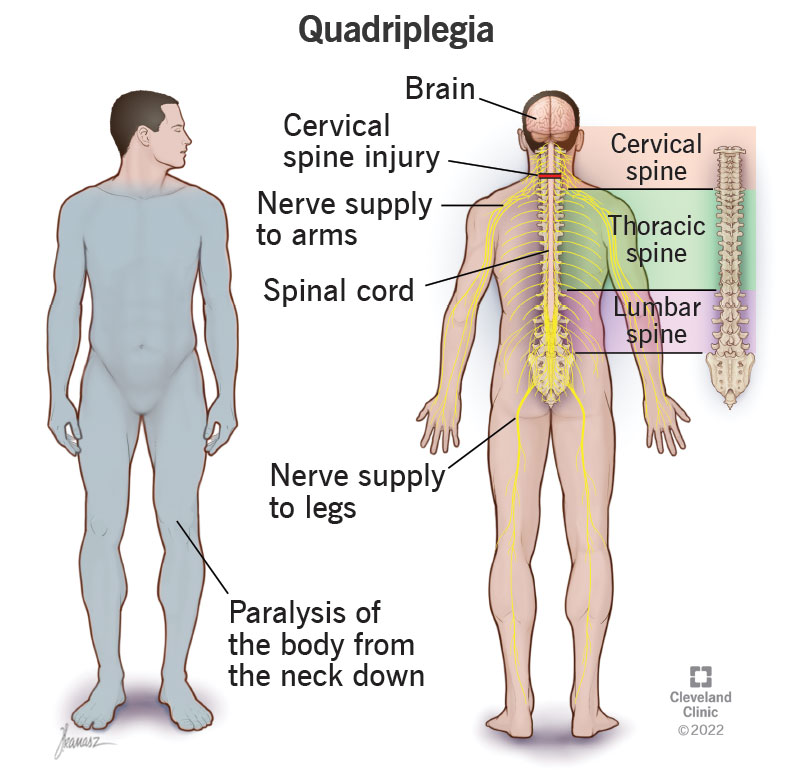 Quadriplegia affects the body from the neck down, causing paralysis and loss of feeling.