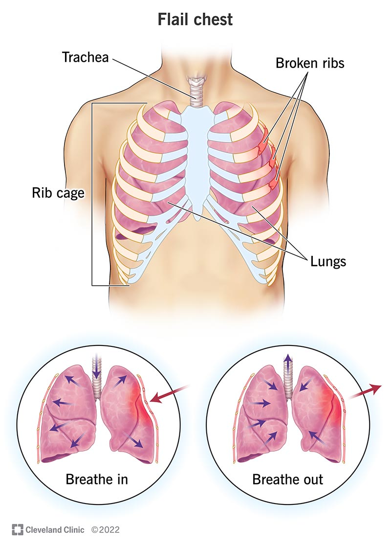 Illustration showing how broken ribs interfere with breathing in a person with flail chest.