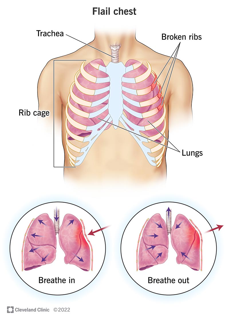 Examples illustrating the rib cage measurements. ( A ) Rib cage