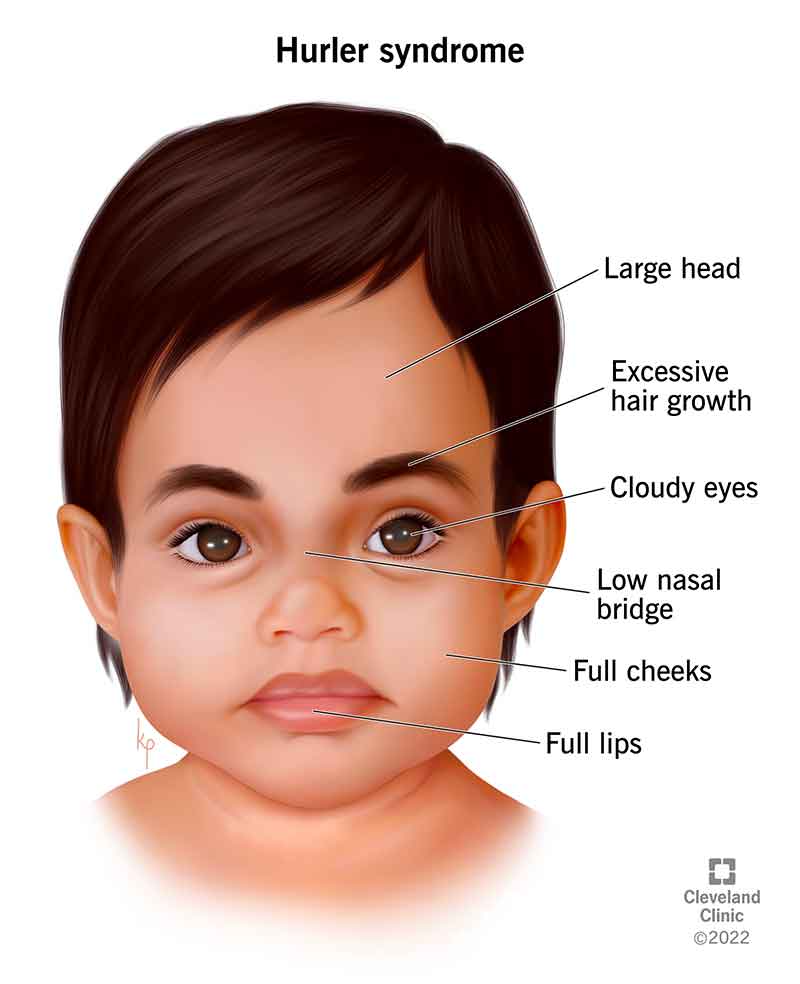 Children born with Hurler syndrome have unique facial characteristics.