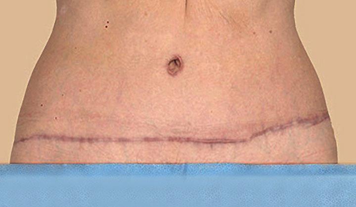 abdominal surgical incisions