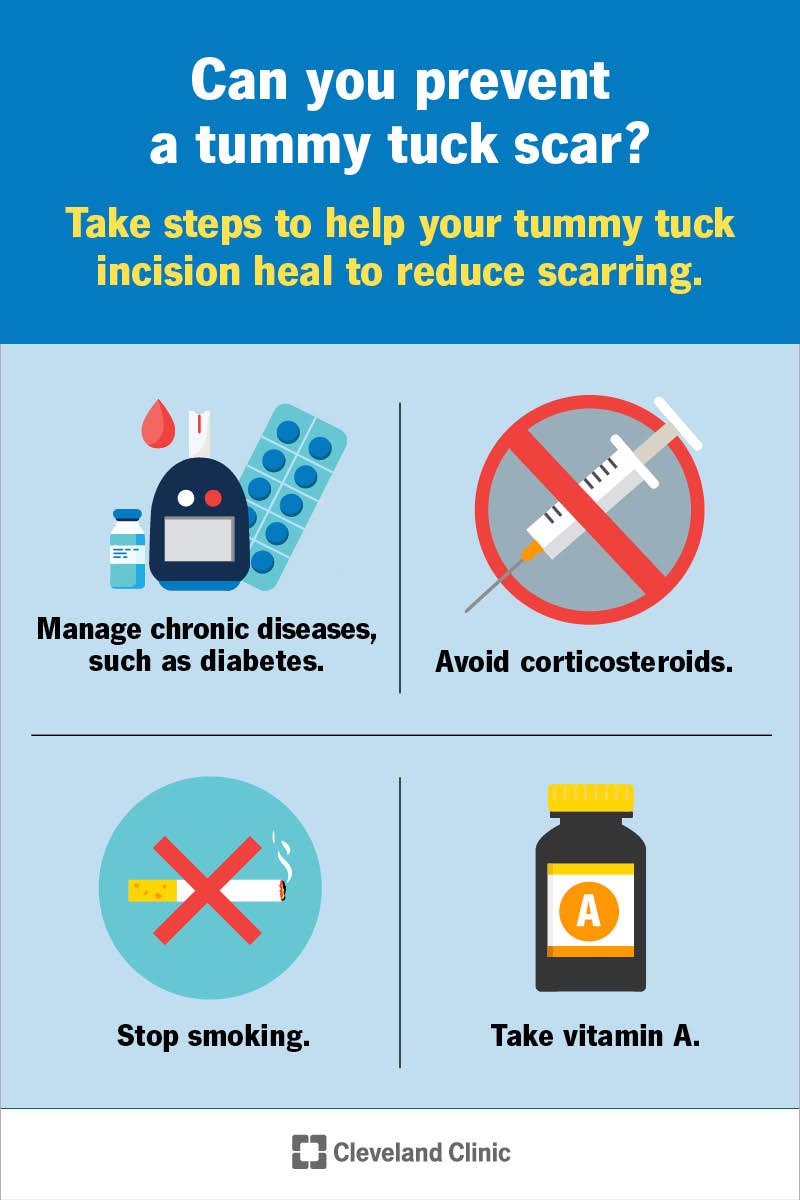 Prevent or reduce the appearance of tummy tuck scars by following your surgeon’s advice after surgery.