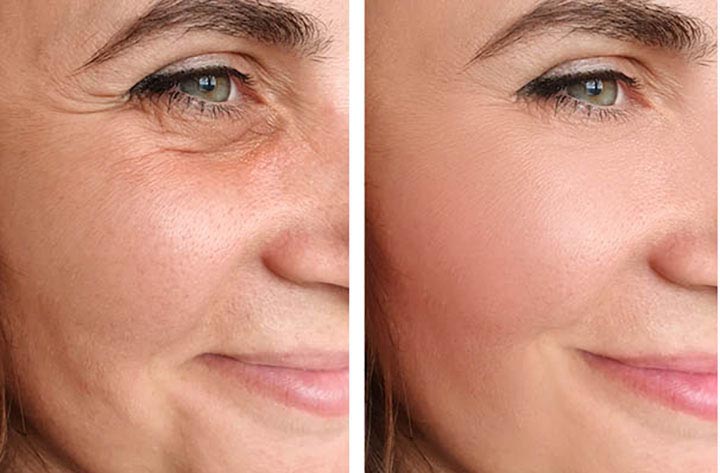 A person’s face before and after a nonsurgical facelift procedure.