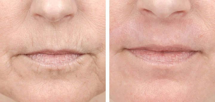 A person’s nose, lips and chin before and after a nonsurgical facelift procedure.