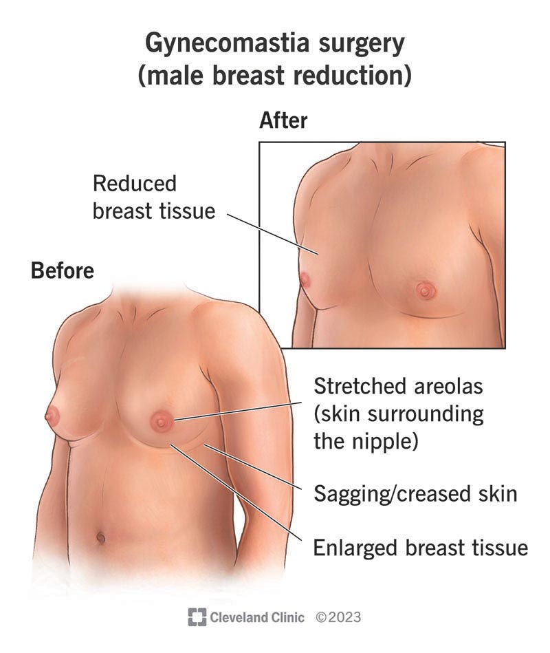 A male chest before and after gynecomastia surgery, which reduces breast size in people with gynecomastia.