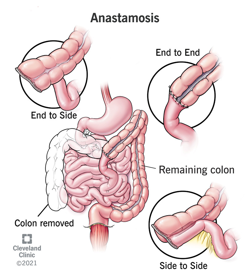 An intestinal anastomosis can be end-to-end, end-to-side or side-to-side.