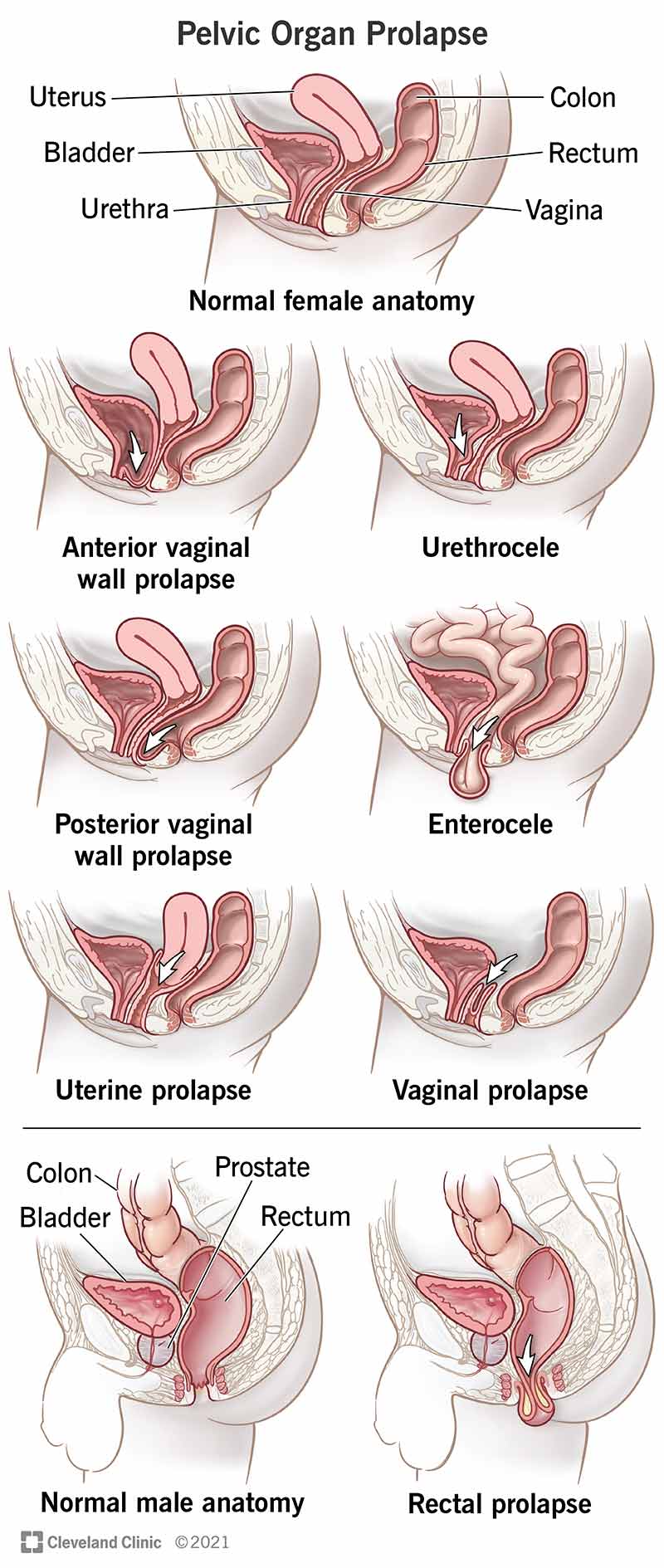 Pelvic organ prolapse involving the bladder, urethra, rectum, small intestine, uterus and vagina