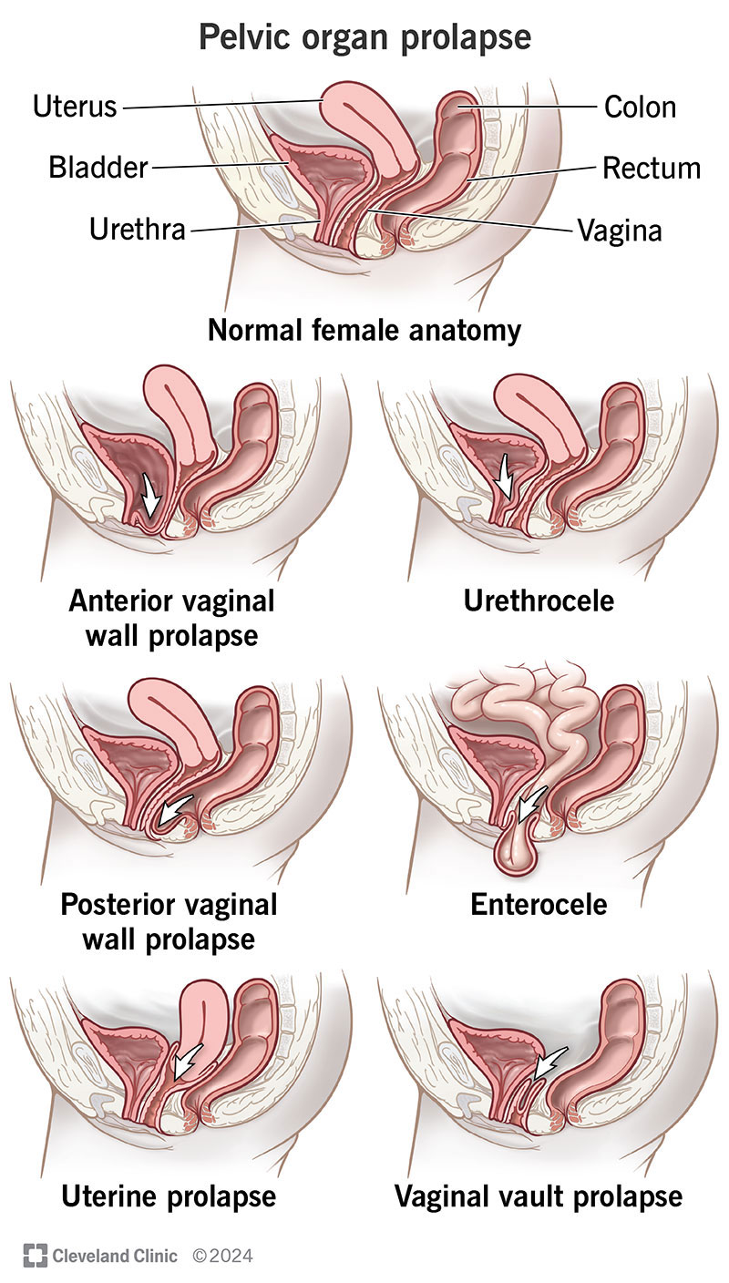 Pelvic Organ Prolapse Types, Causes, Symptoms and Treatment pic