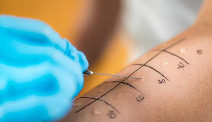 Photo of allergist performing allergy skin testing.