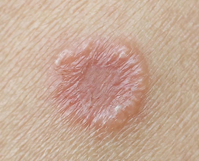 Tinea Manuum: Symptoms, Causes & Treatment