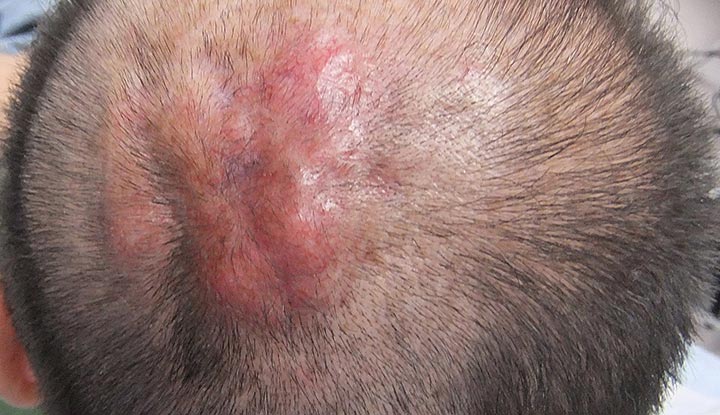 skin cancer scalp treatment