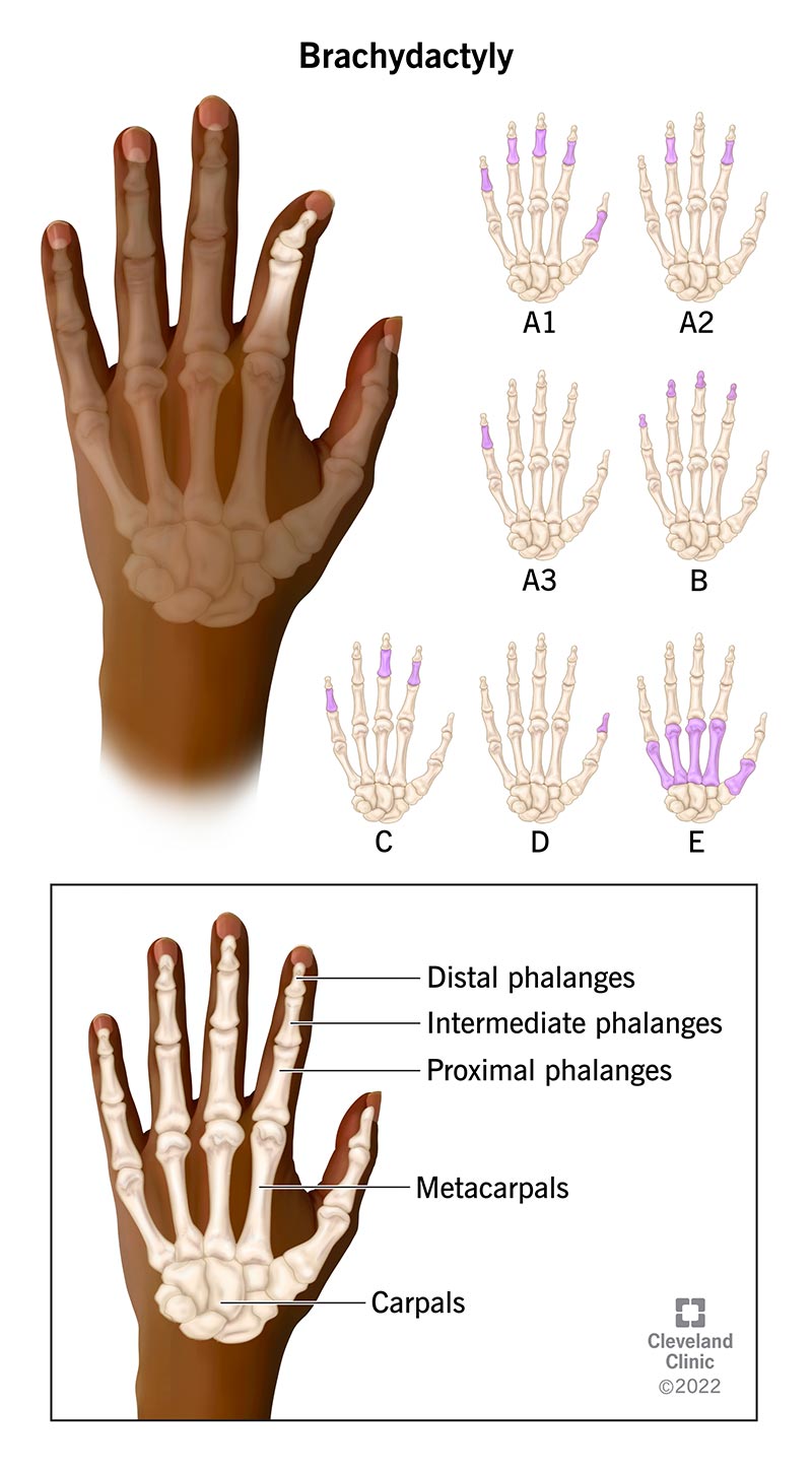 A hand with short fingers caused by brachydactyly.