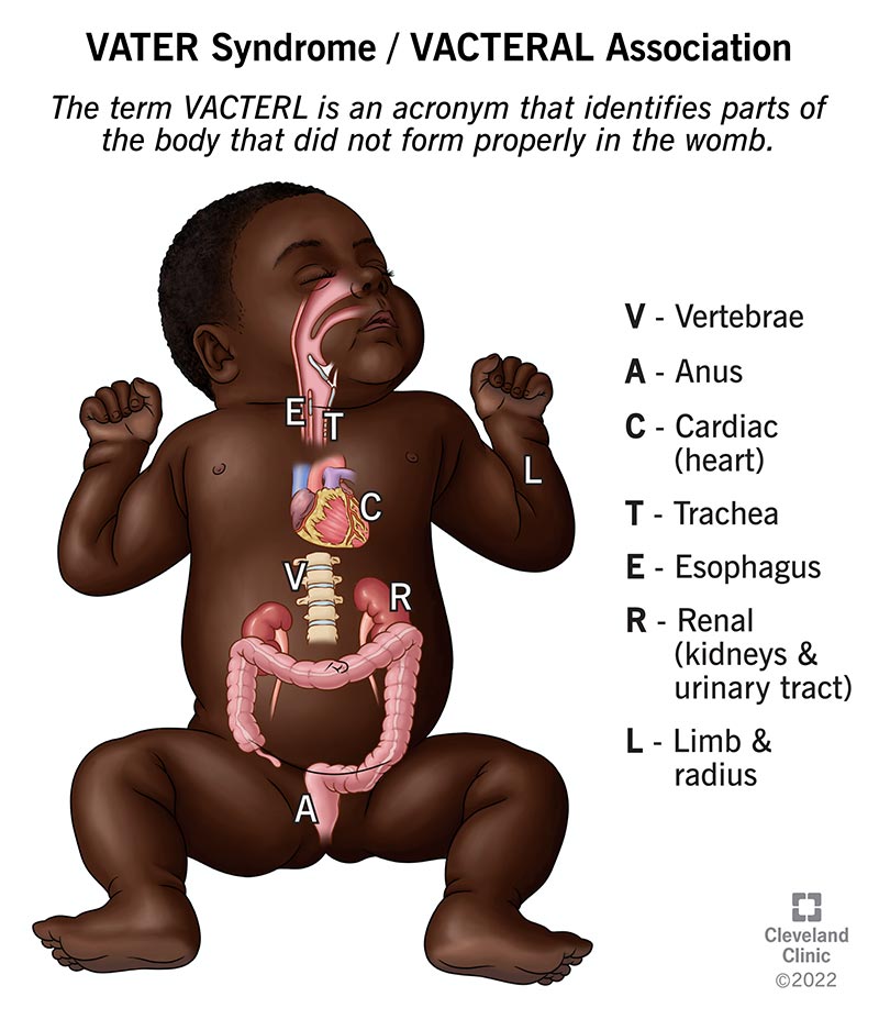 A diagram of a newborn’s organs affected by VATER syndrome (VACTERL association).
