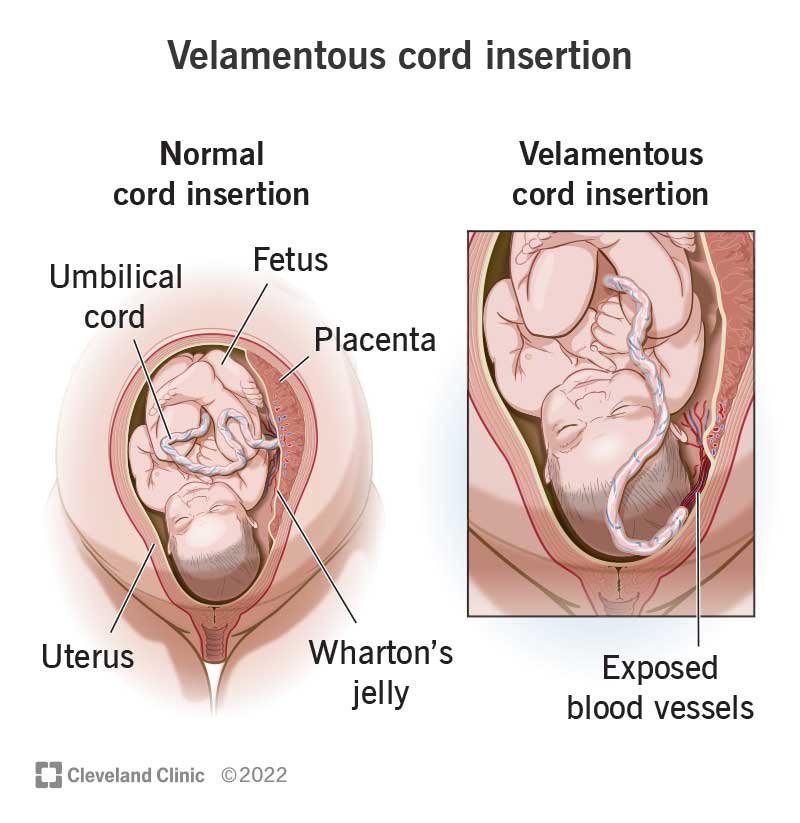 Velamentous cord insertion compared to normal umbilical cord insertion