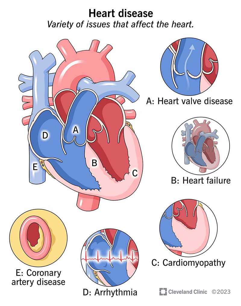 Different kinds of heart disease affect various parts of your heart.