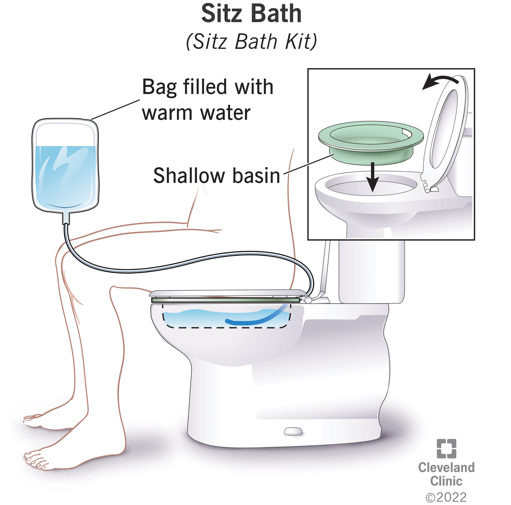 A sitz bath kit is a shallow basin, a plastic bag and a long tube. Use the kit to relieve discomfort in your perineum.