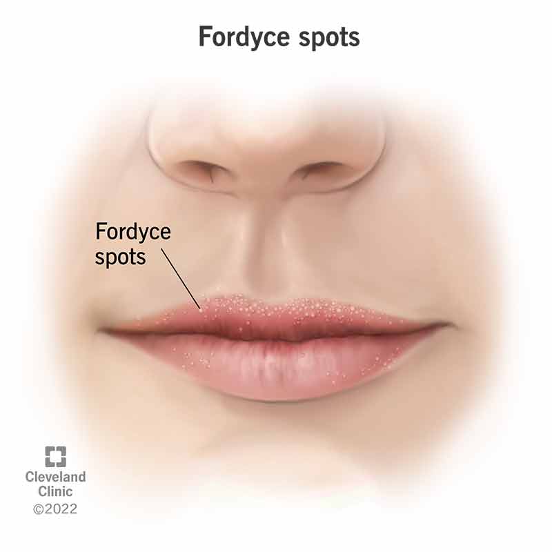 Fordyce spots on the top lip and bottom lip.