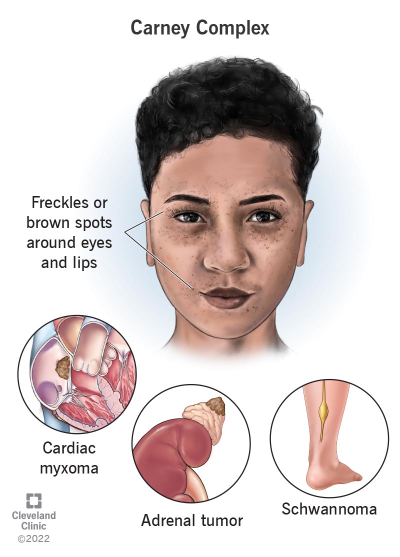 carney syndrome tumors