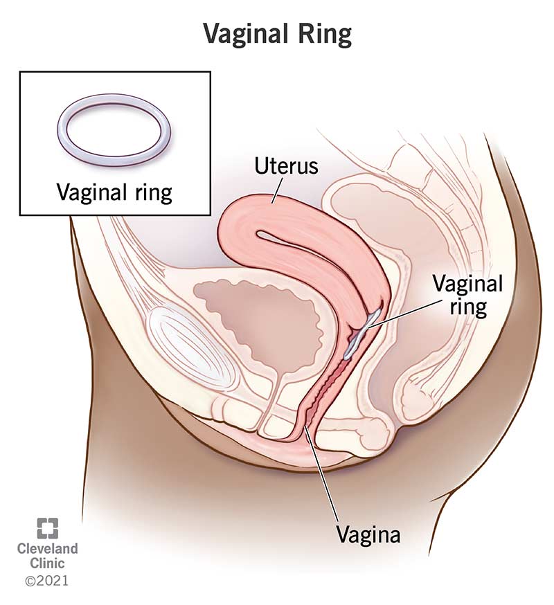 A vaginal ring inside the vagina.