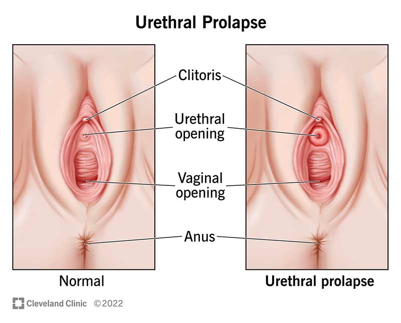 Normal urethra vs. urethral prolapse.