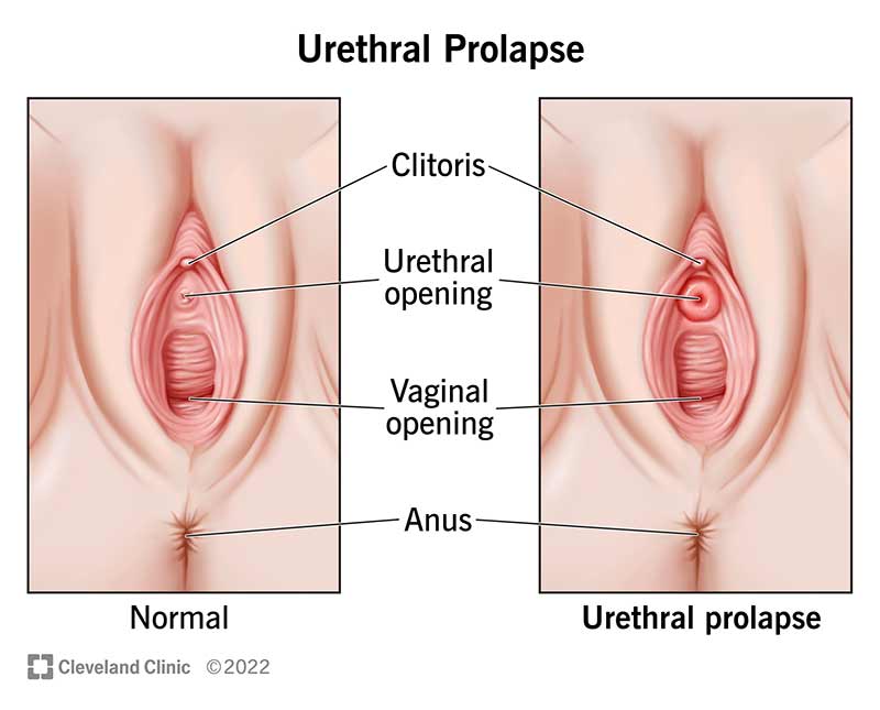 Uterine Prolapse the Do'd and Don'ts