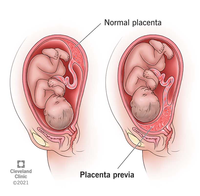 Placenta covering the cervix.