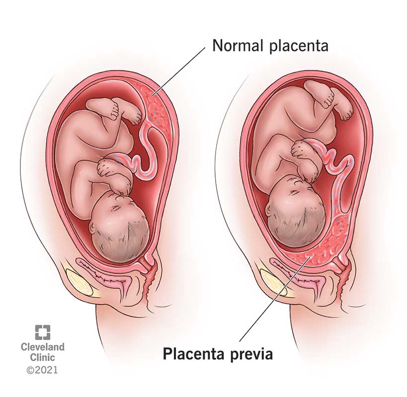 24211 Placenta Previa