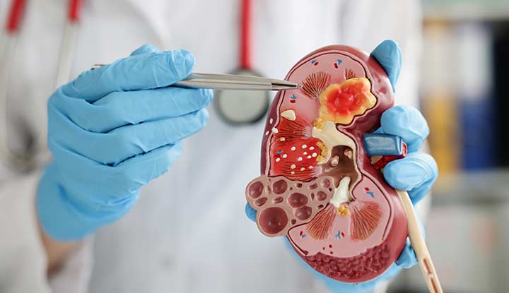 A nephrologist uses a pen to point out a renal pyramid in a kidney model.