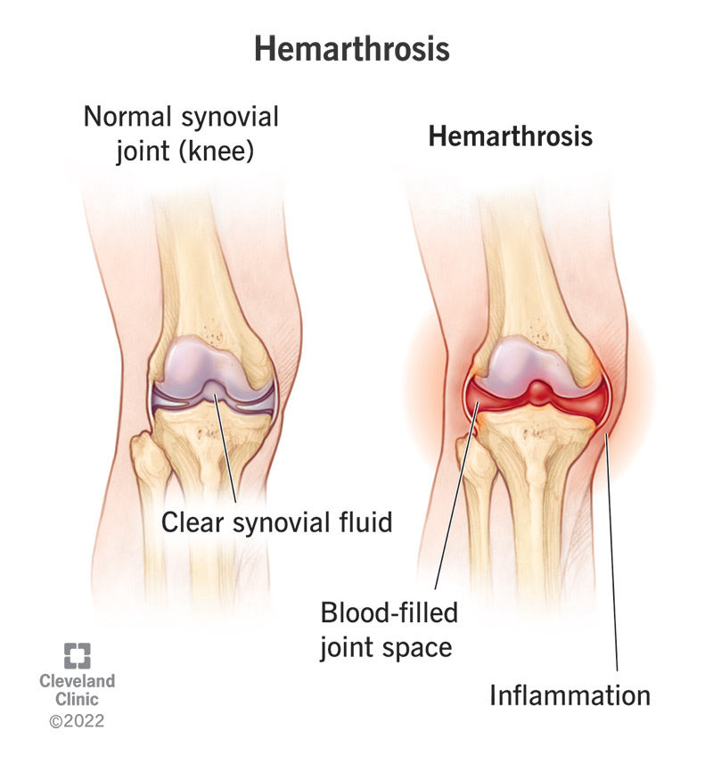 An illustration of hemarthrosis in a knee joint.