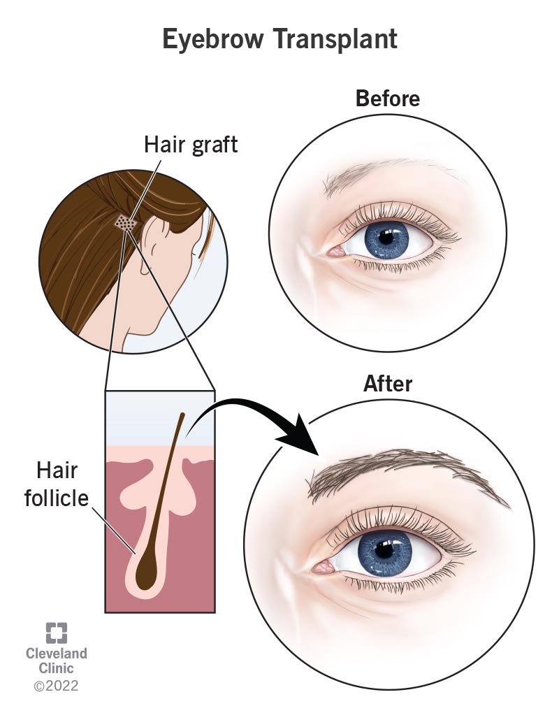 Eyebrows before and after an eyebrow transplant with a hair graft.