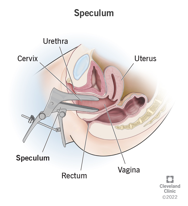 A speculum widening the vaginal walls during a pelvic exam
