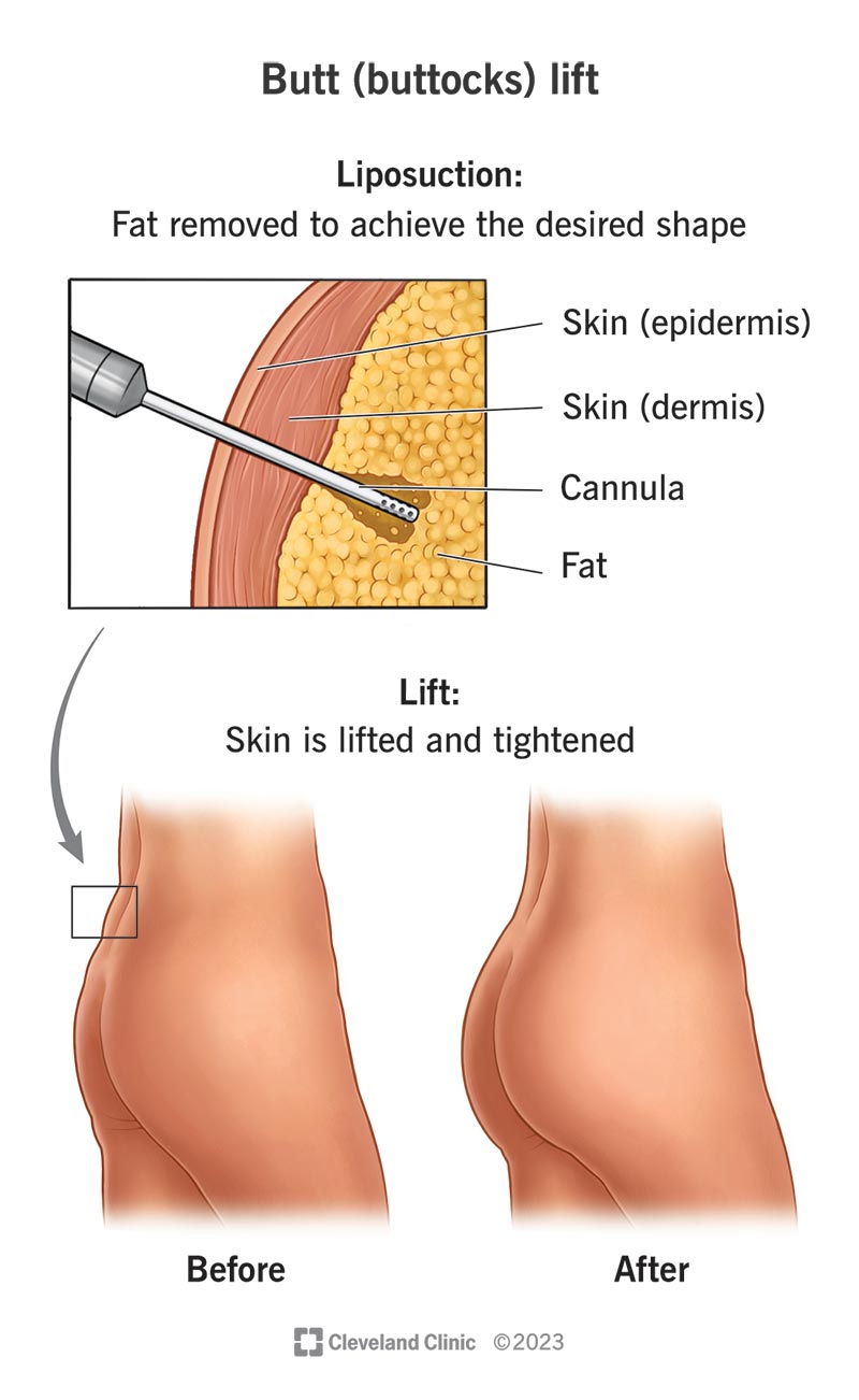 A person’s butt before and after a butt (buttocks) lift, and the liposuction cannula tool in a person’s skin that a surgeon uses to remove fat.